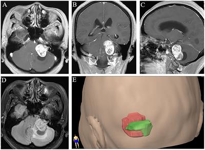 The Relationship Between Peritumoral Brain Edema and the Expression of Vascular Endothelial Growth Factor in Vestibular Schwannoma